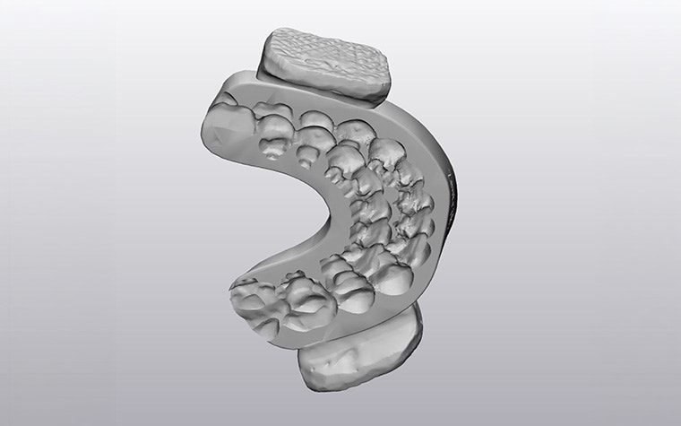 materialise-mimics-enlight-cmf-orthodontics-oral-maxillofacial-surgery-models-teeth-final-doppelimpressionen-splint.jpg
