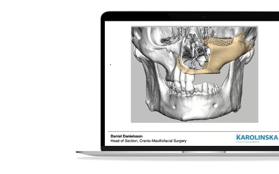 ssm-skull-orthognathic-surgery-3d-printed-model.jpg