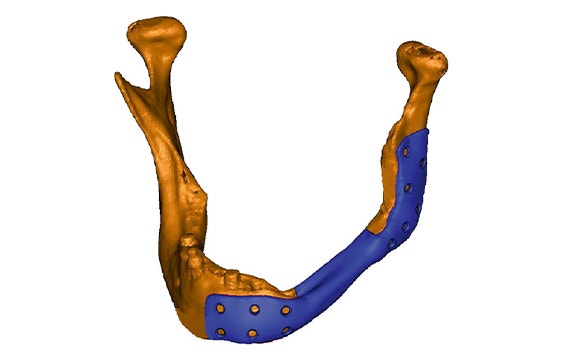 3D model of a jawbone with a personalized implant attached