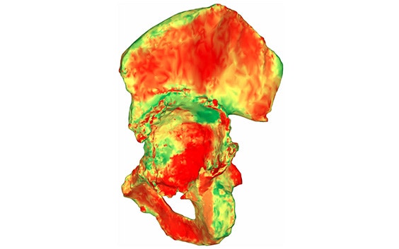 Modelo digital 3D de una cadera con un mapa de colores encima