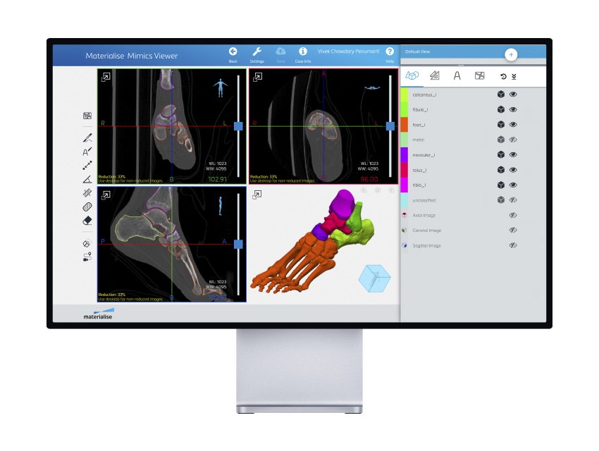 Computer screen with Mimics Viewer showing a patient's foot scans and a 3D model of the foot bones