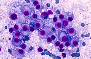 Macro image of multiple myeloma 