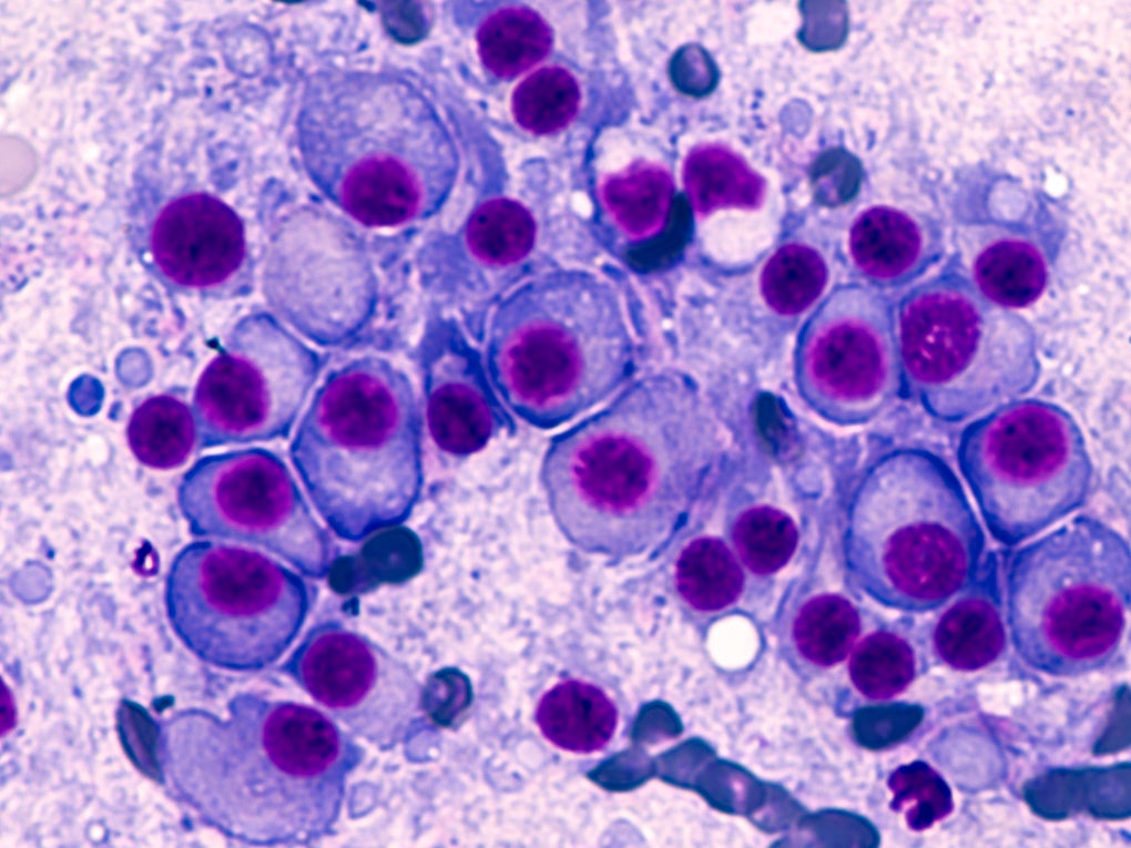 Macro image of multiple myeloma Macro image of multiple myeloma