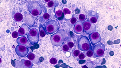 Macro image of multiple myeloma 
