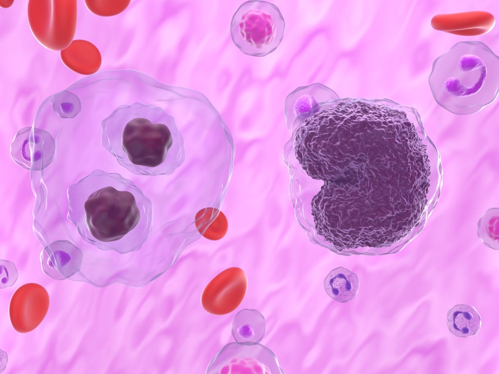Illustration of Hodgkin lymphoma Illustration of Hodgkin lymphoma
