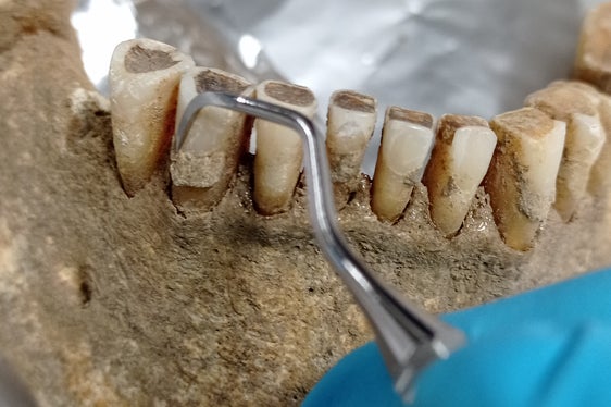 Über Zahnsteinablagerungen mittelalterlicher Mumien werden derzeit Informationen zu Ernährung, Mundgesundheit und Verwendung von Heilpflanzen rekonstruiert. (Foto: LPA/Eurac Research)