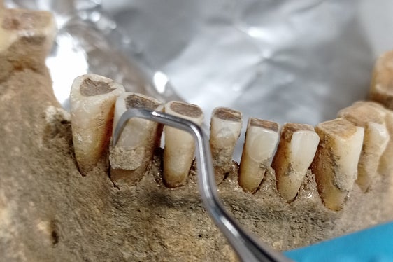 Attualmente, dai depositi di tartaro presenti sulle mummie medievali si stanno ricostruendo informazioni relative all'alimentazione, alla salute orale e all'uso delle piante medicinali. (Foto: USP/Eurac Research)