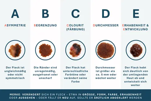 Die ABCDE-Regel hilft bei der Einschätzung von Muttermalen. (Grafik: LPA/Viktoria Huber)