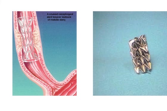 Uno degli esempi pratici illustrati durante il seminario di matematica: stent ripiegato e disteso durante l'inserimento in caso di stenosi coronarica.