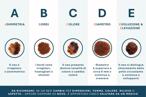 La regola ABCDE aiuta nella valutazione dei nei. (Infografica: USP/Viktoria Huber)
