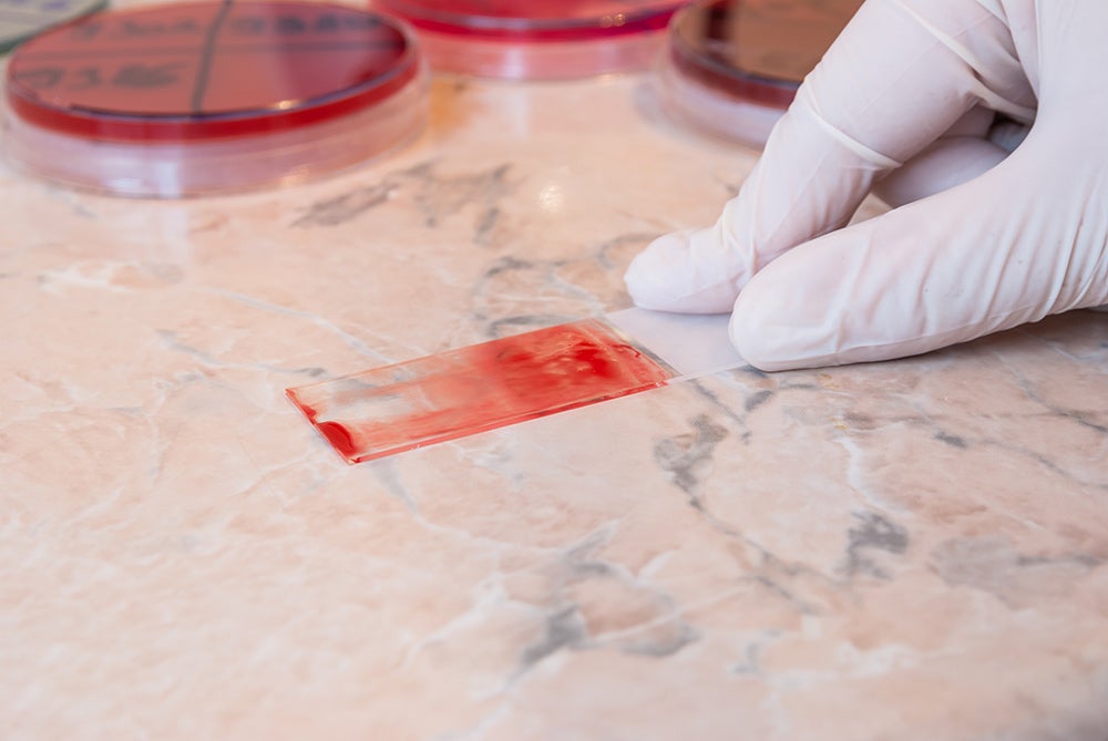 Blood smear test. Credit: Shutterstock.